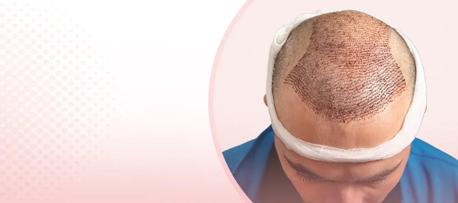 After Hair Transplant