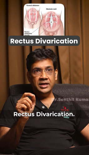 Rectus Divarication
