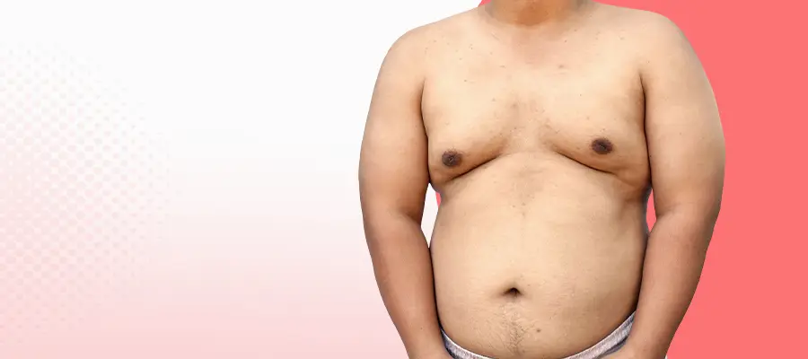 Gynecomastia treatment in Coimbatore