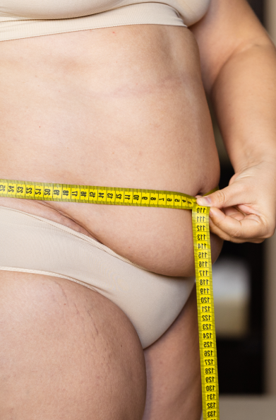 Liposuction Surgery Results
